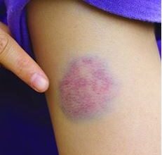 Photo of छोटे-मोटे घावों को भरने में बेहद असरदार हैं ये उपाय