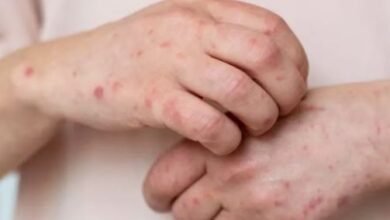 Photo of अमेरिका में Measles का प्रकोप, 483 मामले आए सामने