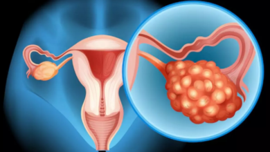 Photo of Ovarian Cyst होने पर शरीर में नजर आते हैं ये लक्षण, जानें कारण और बचाव के तरीके